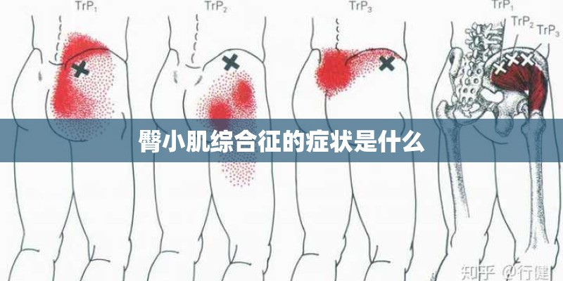 臀小肌综合征的症状是什么